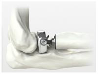 ALIGN radial head system: image from Skeletal Dynamics